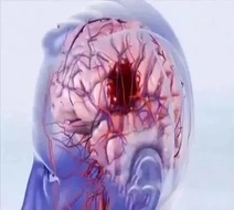 体检查出颈动脉斑块，该怎么办？