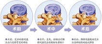 颈、腰椎病治疗新技术--经皮穿刺射频椎间盘消融术